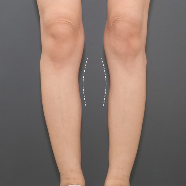 오다리 교정 필러