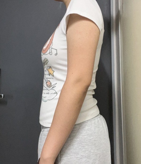 팔뚝 지방분해주사