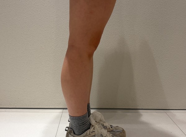 종아리 지방분해주사