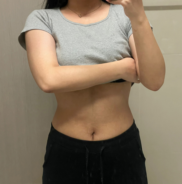 복부 지방분해주사