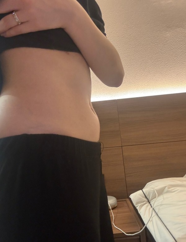 복부 지방분해주사