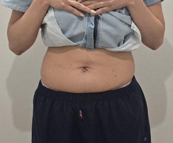 복부 지방분해주사