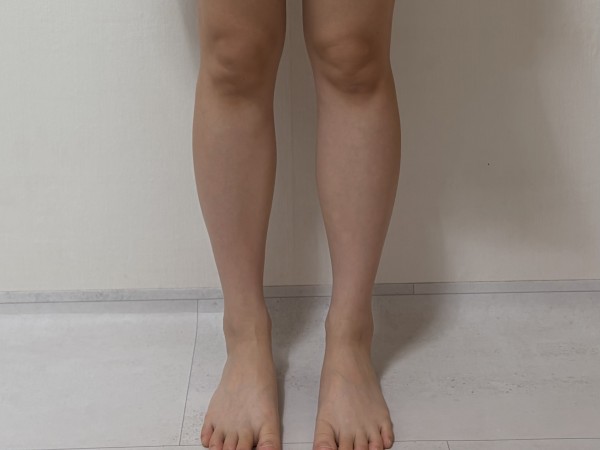 종아리 지방분해주사